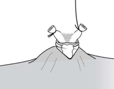 Ligadura (anudar) de los extremos del conducto deferente
